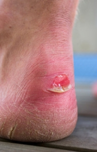 Why CMA Attendees Have Suffered From Blisters
