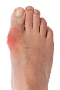 Truck Driver Lifestyle Problematic For Gout Sufferers