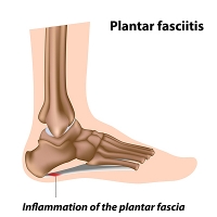 That Pain in Your Feet May be Plantar Fasciitis